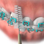Affordable Clear Braces & Expert Overbite Correction in League City – Smile with Confidence!