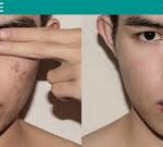 Best Acne Scar Treatment: Effective Ways to Smooth and Clear Your Skin