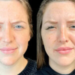 How Botox Treatments in Dubai Help with Migraine Relief