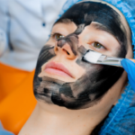 Can Laser Carbon Peel Remove Blackheads and Whiteheads?