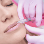 Can Lip Fillers Give You Smooth and Hydrated Lips?
