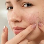 Can Pimples Treatment Calm Sudden Facial Acne Flare-Ups?