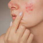 Can pimples treatment help achieve spotless glowing skin?