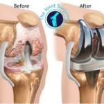 Cost of a Knee Replacement Privately Accurate Prices, What’s Included, and How to Compare Providers
