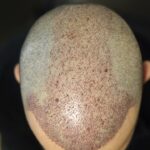 Does Hair Transplant Stop Future Hair Loss
