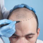 Does Hair Transplant Stop Future Hair Loss?