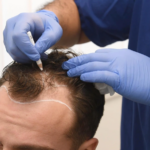 Does Hair Transplant Stop Future Hair Loss?