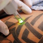 Does Laser Tattoo Removal Affect Natural Skin Pigmentation?