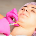Does Mesotherapy Treatments Help Reduce Fine Lines?