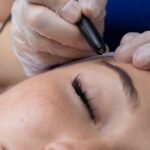 Does Plasma Pen Treatment Lift Sagging Skin?