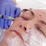 Does Vampire Facial Help with Sun-Damaged Skin Repair?