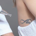 Does laser tattoo removal really work on old tattoos?
