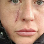 How Does Scar Removal Improve Overall Facial Appearance?