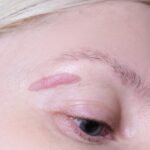 How Effective Is Keloid Treatment For Raised Keloid Scars?
