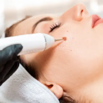 Is Warts Removal Treatment Good for Facial Warts?