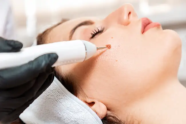 Is Warts Removal Treatment Good for Facial Warts?
