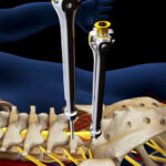 What is the recovery time for a slipped disc surgery?