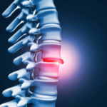 Is Sciatica Causing Your Leg Pain and Discomfort?