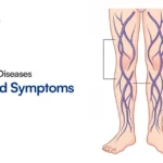 Varicocele Embolization: Safe & Effective Treatment Guide