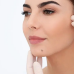 What Areas Can Mole Removal Treat Best?