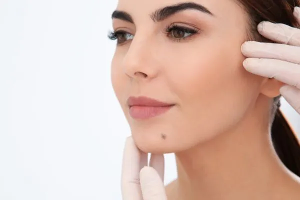 What Areas Can Mole Removal Treat Best?