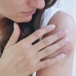 What Causes Keloids to Form on Certain Skin Types?