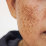What Causes Melasma and How Can It Be Treated?