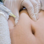 What Is Aqualyx Injection and How Does It Help?