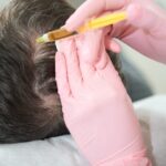 What Makes PRP a Good Solution for Hair Thinning?