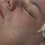 What Makes Vampire Facial a Popular Anti Aging Option?