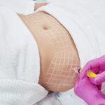 Why Choose Fat Dissolving Injections For Targeted Fat Loss?