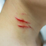 Why Is Scar Removal Important for Skin Health?