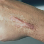 Why Is the Best Scar Removal Popular for Skin Repair?