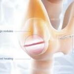 Microwave Ablation for Thyroid Nodule: Safe & Effective Care