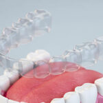 The Hidden Key to a Lasting Smile: Teeth Retainers in Islamabad