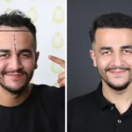 Best Hair Transplant Turkey: What to Eat and Avoid During Recovery