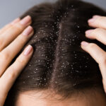 Best Anti-Dandruff Shampoo & Hair Care Guide