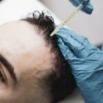 What Makes GFC Treatment a Choice for Hair Thinning