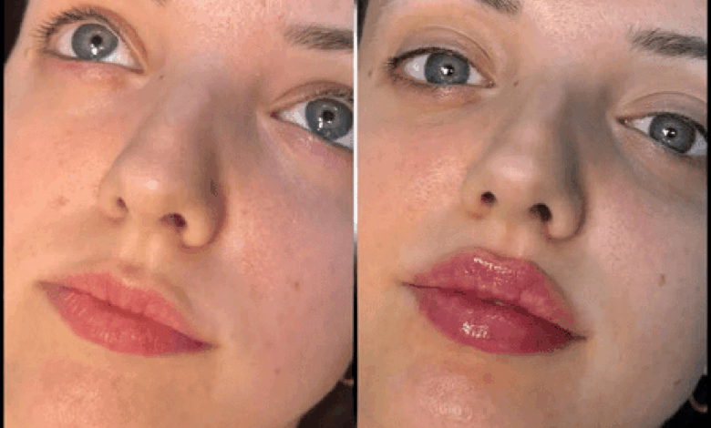 Fillers Treatment in Dubai: Choosing the Right One