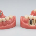 Dentures vs Dental Implants: Which Is Better?