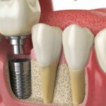 Why Pre-Treatment Evaluation Shapes the Entire Dental Implant Process