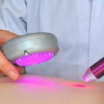 Advanced Cold Laser Solutions for Better Care and Recovery