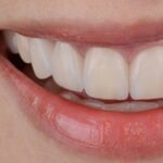 The Benefits of Straightening Teeth with Nearly Invisible Aligners