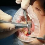 Affordable Dental Implants vs. Dentures: How Do They Compare?