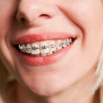 Your Journey to a Straighter Smile With Braces in Ft. Collins