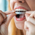 What Makes Clear Aligners a Popular Orthodontic Choice
