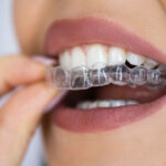Considering invisalign during dental development