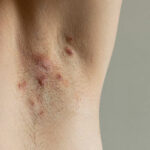 Best Supplements for Hidradenitis Suppurativa: A Guide to Nutritional Support
