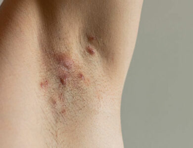 Best Supplements for Hidradenitis Suppurativa: A Guide to Nutritional Support