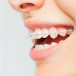 Preparing for a successful orthodontic treatment journey